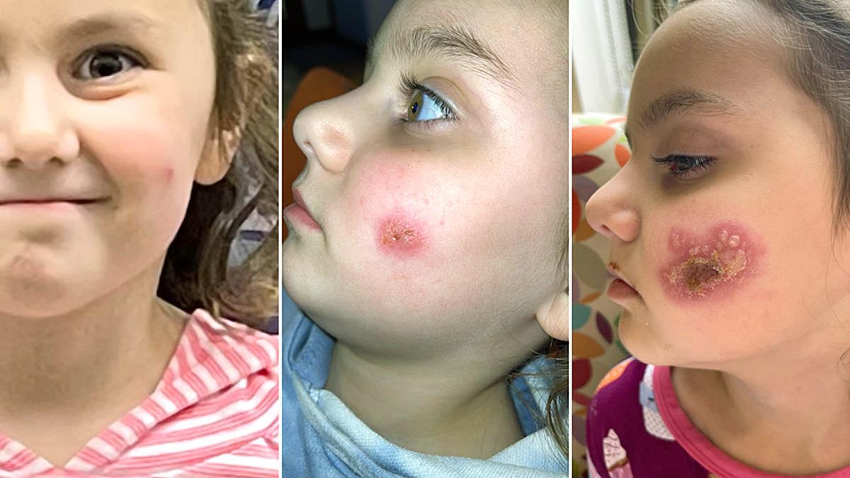 Το αθώο φιλί της μαμάς της, την έστειλε στο νοσοκομείο με σοβαρή λοίμωξη!