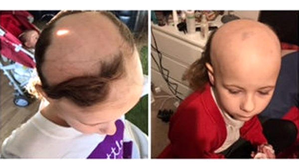 10χρονη έχασε τα μαλλιά της λόγω bullying - έπαθε αλωπεκίαση από το άγχος