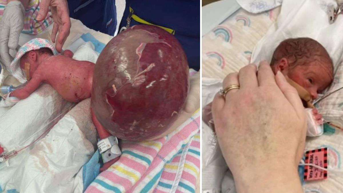 Ιατρικό θαύμα: σώθηκε προωράκι που γεννήθηκε με όγκο 2 κιλών!