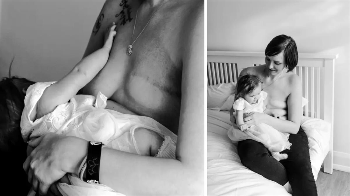 «Η μαστεκτομή δεν με εμπόδισε να θηλάσω - κοίταζα το μωρό μου και έπαιρνα δύναμη»