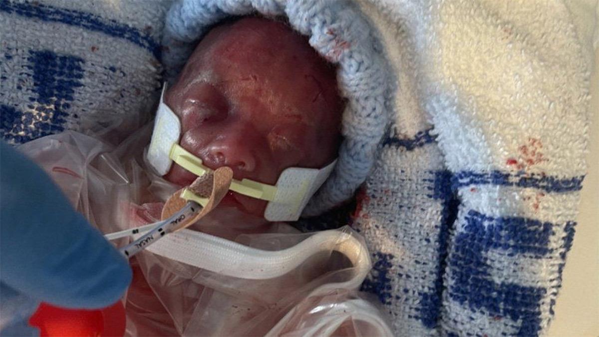 Προωράκι που γεννήθηκε στις 22 εβδομάδες κατάφερε να επιβιώσει και δυναμώνει καθημερινά!