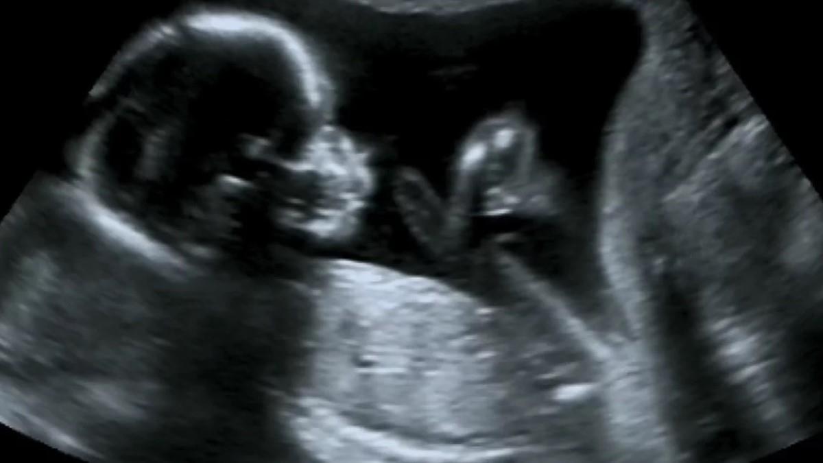 Πρωτοποριακή επέμβαση έσωσε έμβρυο: το εγχείρησαν στον εγκέφαλο μέσα από την κοιλιά της μαμάς του