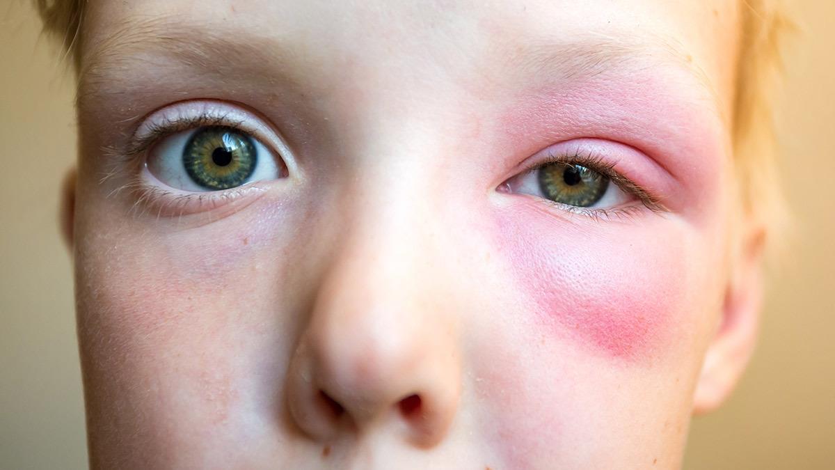 Σμήνος μελισσών επιτέθηκε σε 12χρονο αγόρι στη Χαλκίδα - υπέστη αλλεργικό σοκ