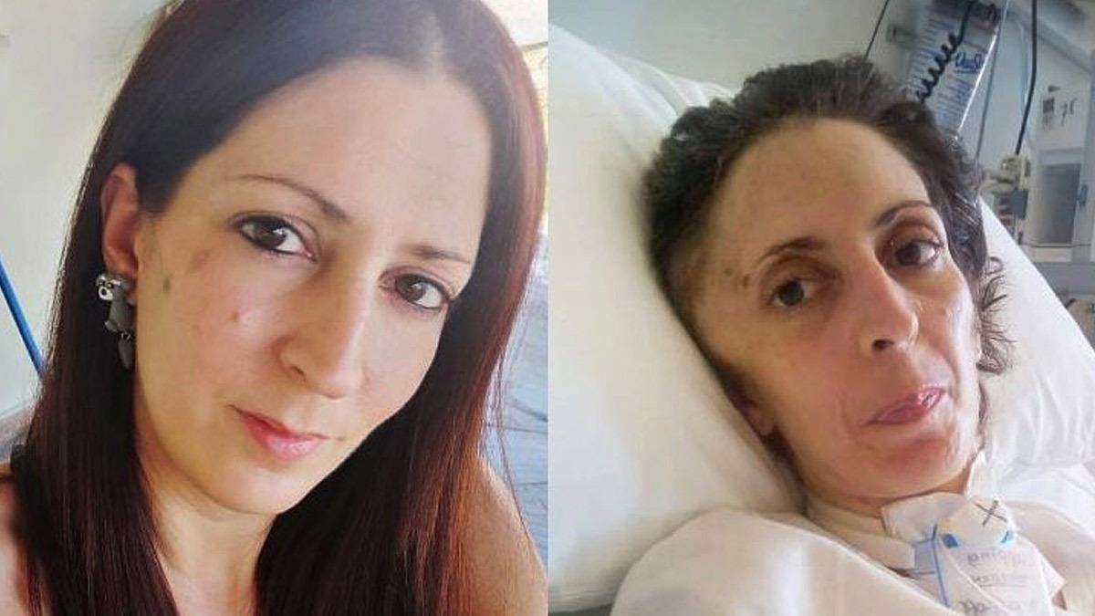 Αργυρούπολη: πέθανε η 41χρονη Όλγα που είχε κακοποιηθεί βάναυσα από τον σύντροφό της