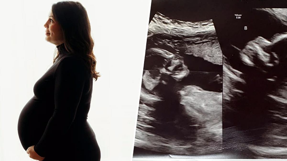 Γυναίκα με 2 μήτρες έμεινε έγκυος σε 2 μωρά - 1 στην κάθε μία!