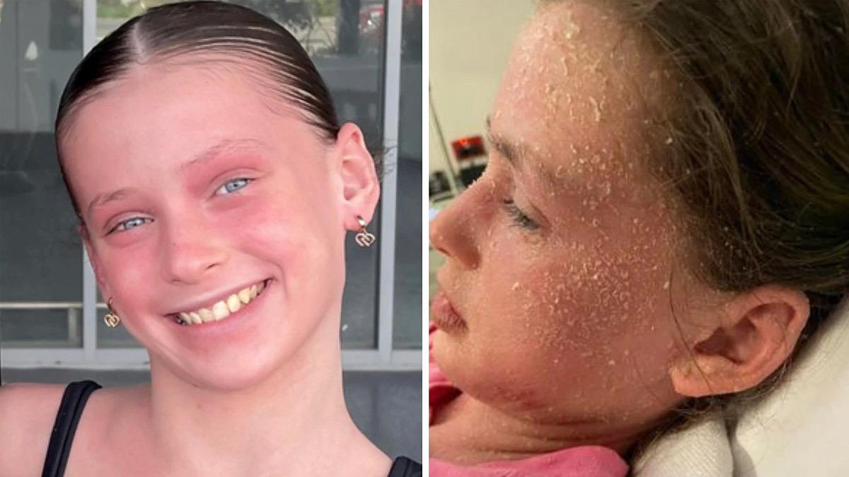 11χρονη είναι αλλεργική στα ίδια της τα δάκρυα και τον ιδρώτα!