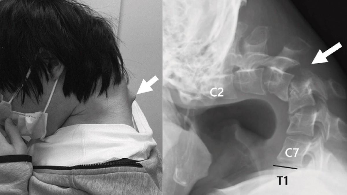 25χρονος στράβωσε τον αυχένα του επειδή ήταν όλη μέρα σκυφτός στο κινητό του