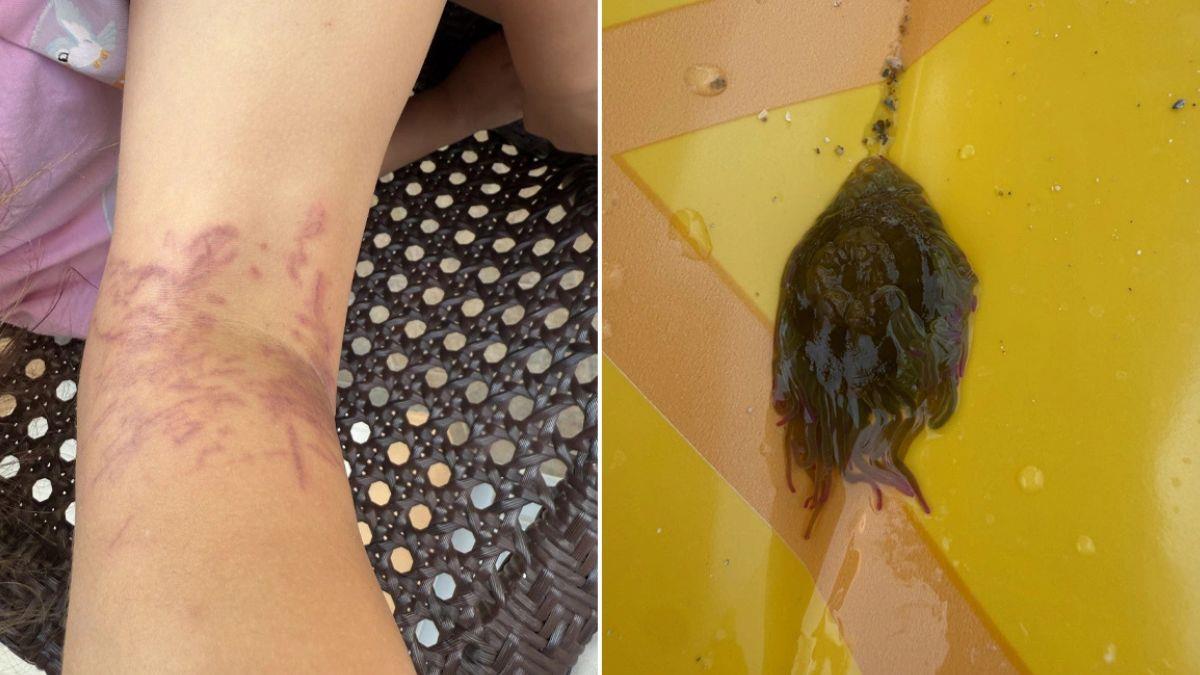 Κέα: δηλητηριώδης θαλάσσια ανεμώνη τσίμπησε 6χρονη - γύρισε στην Αθήνα για νοσηλεία