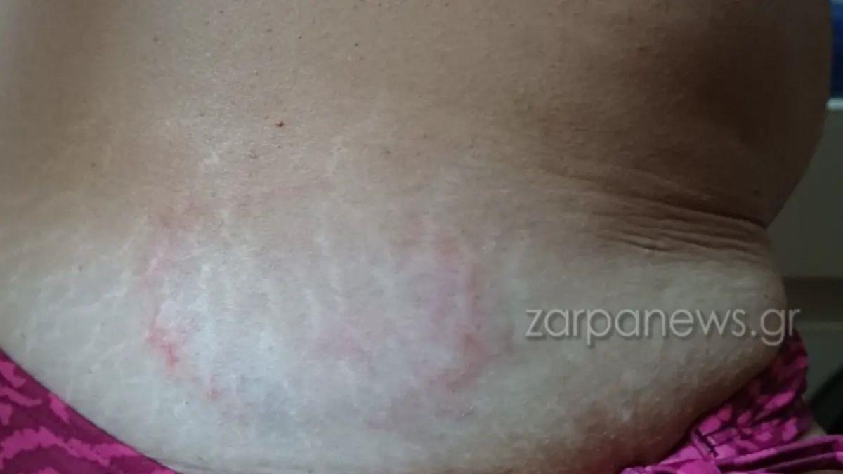 Χανιά: θαλάσσια χελώνα δάγκωσε γυναίκα στο Μαράθι