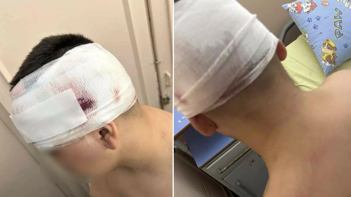 Άγριος ξυλοδαρμός 13χρονου - τον έστειλαν στο νοσοκομείο επειδή μίλησε σε κορίτσια