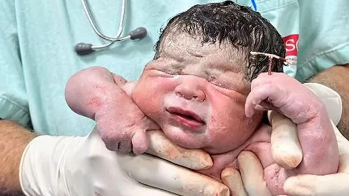 Μωρό γεννήθηκε κρατώντας το... σπιράλ της μαμάς του στο χέρι!