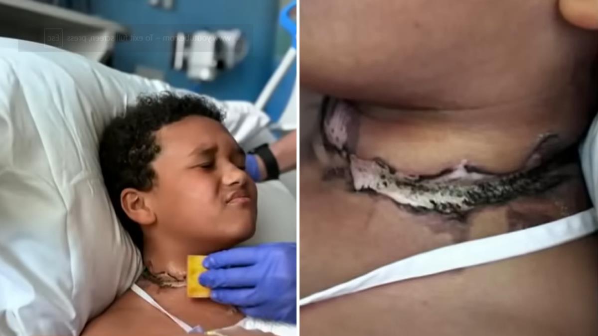 9χρονος υπέστη σοβαρό έγκαυμα - η αλυσίδα του μπλέχτηκε σε φορτιστή ενώ κοιμόταν