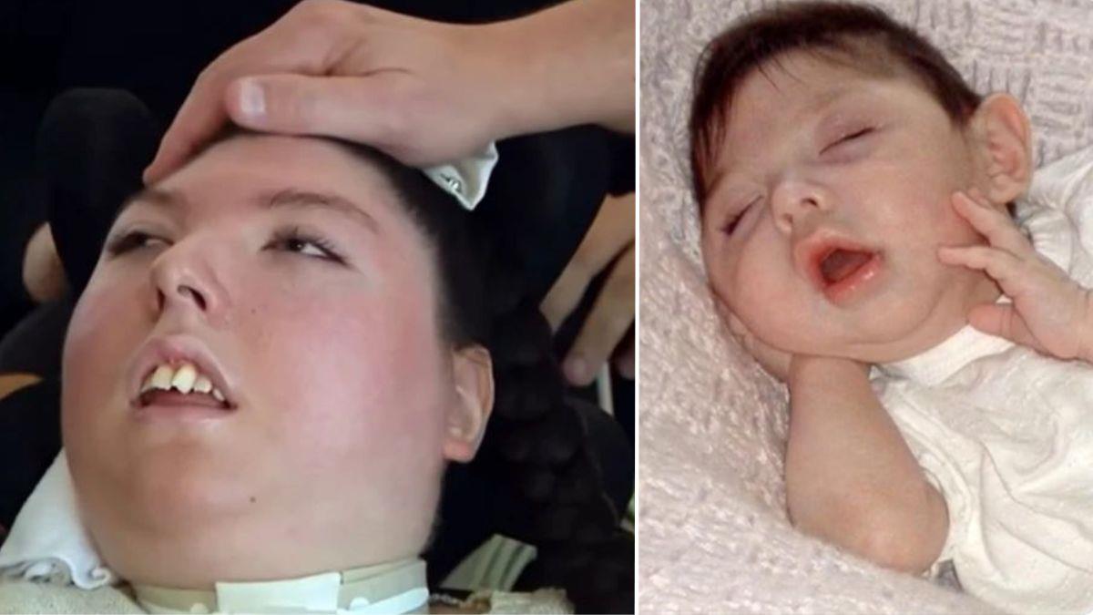 Ιατρικό «θαύμα»: το κορίτσι που γεννήθηκε σχεδόν χωρίς εγκέφαλο έγινε 20 χρονών!