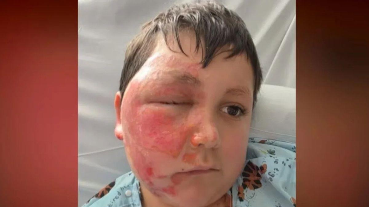 Επικίνδυνο challenge του TikTok έστειλε 9χρονο στο νοσοκομείο με εγκαύματα στο πρόσωπο!