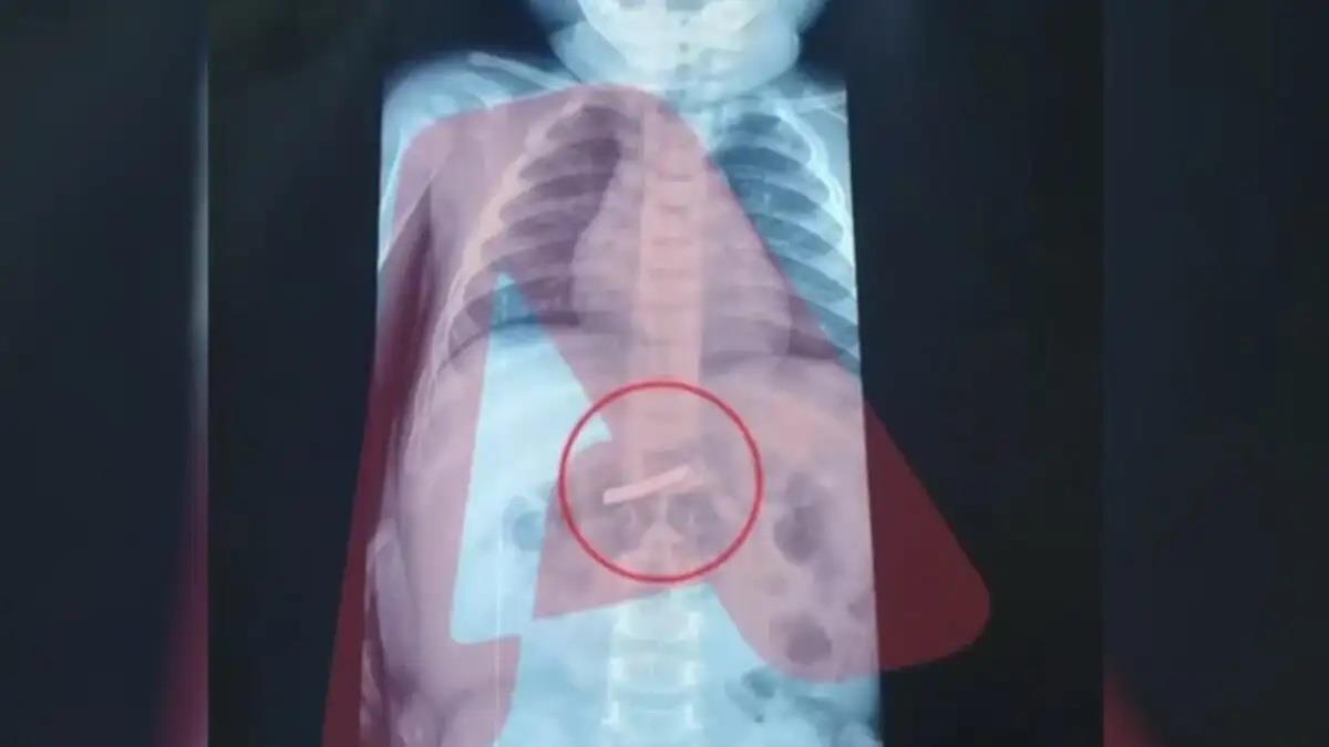 Αγωνιά για 3χρονο που κατάπιε ξυραφάκι - νοσηλεύεται στο Παίδων