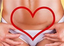 3 μεγάλες αλήθειες για τις μαμάδες που έχουν κάνει καισαρική