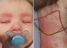 Αληθινές μαρτυρίες γονέων για την  μηνιγγίτιδα Β και πώς θα προφυλάξετε τα παιδιά σας 