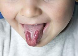 Στοματίτιδα στα παιδιά: Πώς εκδηλώνεται και πώς αντιμετωπίζεται