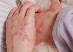 Οι σοβαρές παιδικές ασθένειες που δεν πρέπει να προσπερνάμε