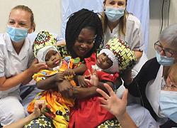 Γιατροί χωρίζουν σιαμαία δίδυμα που ήταν ενωμένα στο κεφάλι με 3D τεχνολογία