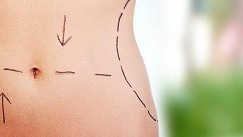Κοιλιοπλαστική μετά τον τοκετό: Πότε, πώς και με πόσα