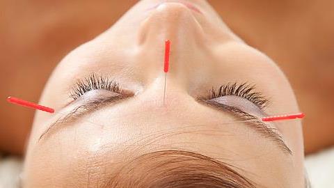 Βελονισμός: Τι είναι και ποιες παθήσεις θεραπεύει