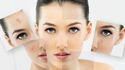 Ακμή ενηλίκων: Πού οφείλεται και πώς αντιμετωπίζεται