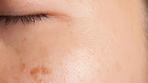 Πανάδες: Που οφείλονται και πώς αντιμετωπίζονται