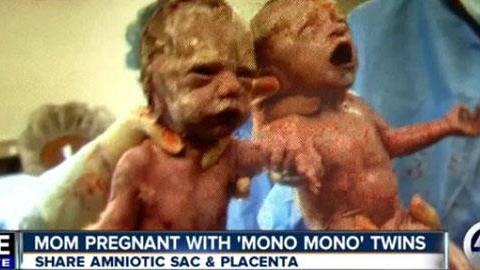 Το θαύμα της ζωής: Δίδυμα γεννήθηκαν πιασμένα χέρι-χέρι (βίντεο)