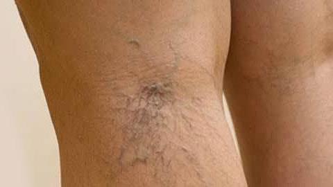 Ευρυαγγείες: Πού οφείλονται και πώς θα τις εξαφανίσετε!