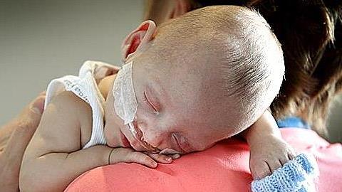 Επιστημονικό θαύμα: Ελληνόπουλο γεννήθηκε μόλις 395 γραμμάρια και... επέζησε!