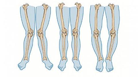 Δωρεάν εξετάσεις σε παιδιά που πάσχουν από ραιβοϊπποποδία στο Ιασώ Παίδων