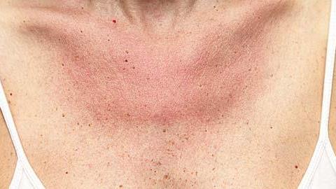 Οι δερματοπάθειες του καλοκαιριού και πώς να απαλλαχθείτε