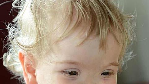 Δείτε το κοριτσάκι που γεννήθηκε χωρίς μύτη!