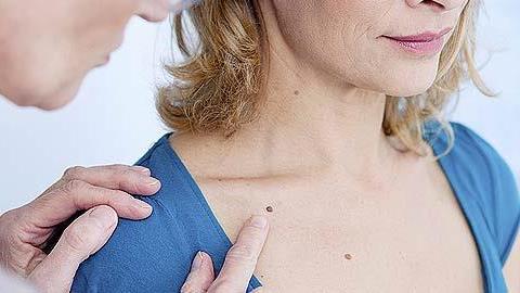 Πώς πρωτοεμφανίζεται ο καρκίνος του δέρματος: Δείτε τις εικόνες!