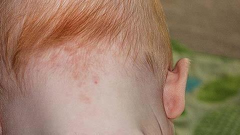 Εκ γενετής σημάδια στο μωρό: Τι να προσέχετε