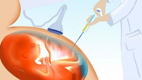 Τι είναι η αμνιοπαρακέντηση και πότε πρέπει να την κάνετε