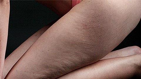 Κυτταρίτιδα: Όσα πρέπει να ξέρετε και πώς να απαλλαγείτε