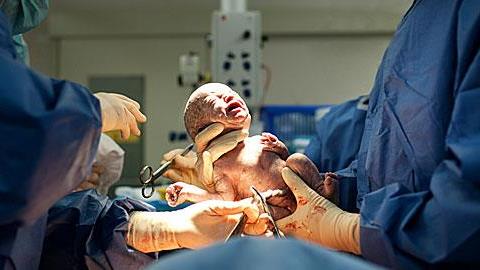 Τι να περιμένετε αν πρόκειται να κάνετε καισαρική