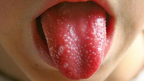 Οστρακιά σε παιδιά: Τα συμπτώματα, οι κίνδυνοι και η θεραπεία