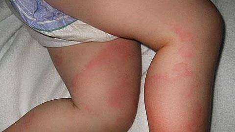 Μωρό με κόκκινα σπυράκια στα πόδια