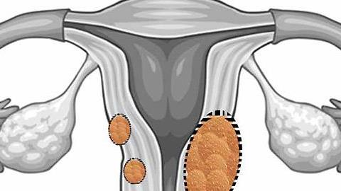 Θα καταφέρω να μείνω έγκυος με τόσα ινομυώματα;