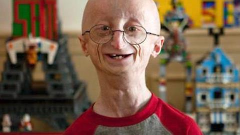 Οι 10 πιο σπάνιες ασθένειες στην ιστορία της ανθρωπότητας