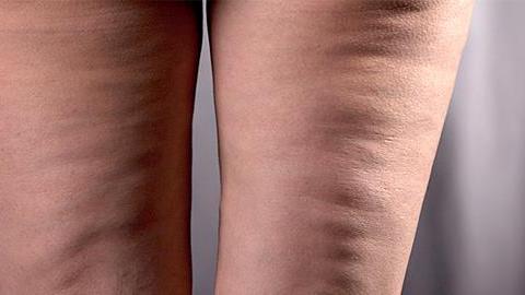 Σπιτική συνταγή κατά της κυτταρίτιδας