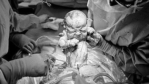 Συγκλονιστικές φωτογραφίες καισαρικής που κόβουν την ανάσα!