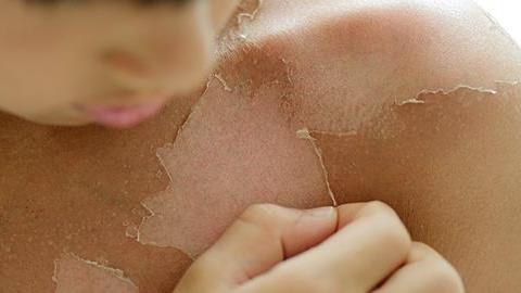 Τι να κάνετε αν το παιδί πάθει έγκαυμα από τον ήλιο