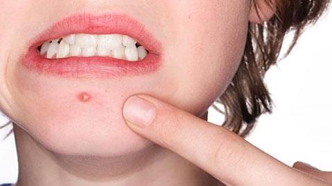 Σταφυλόκοκκος σε παιδιά: Τα συμπτώματα και η θεραπεία