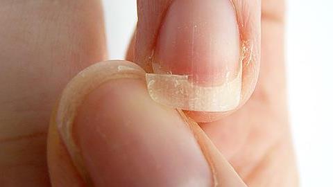 Τι μαρτυρούν τα νύχια για την κατάσταση της υγείας σας;