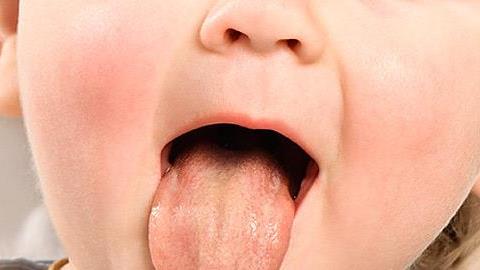 Μωρό με μακρογλωσσία