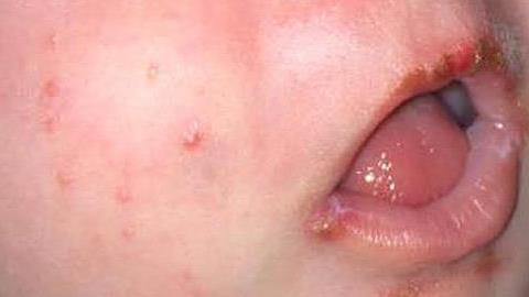 Πώς ένα φιλί έθεσε σε κίνδυνο τη ζωή ενός μωρού